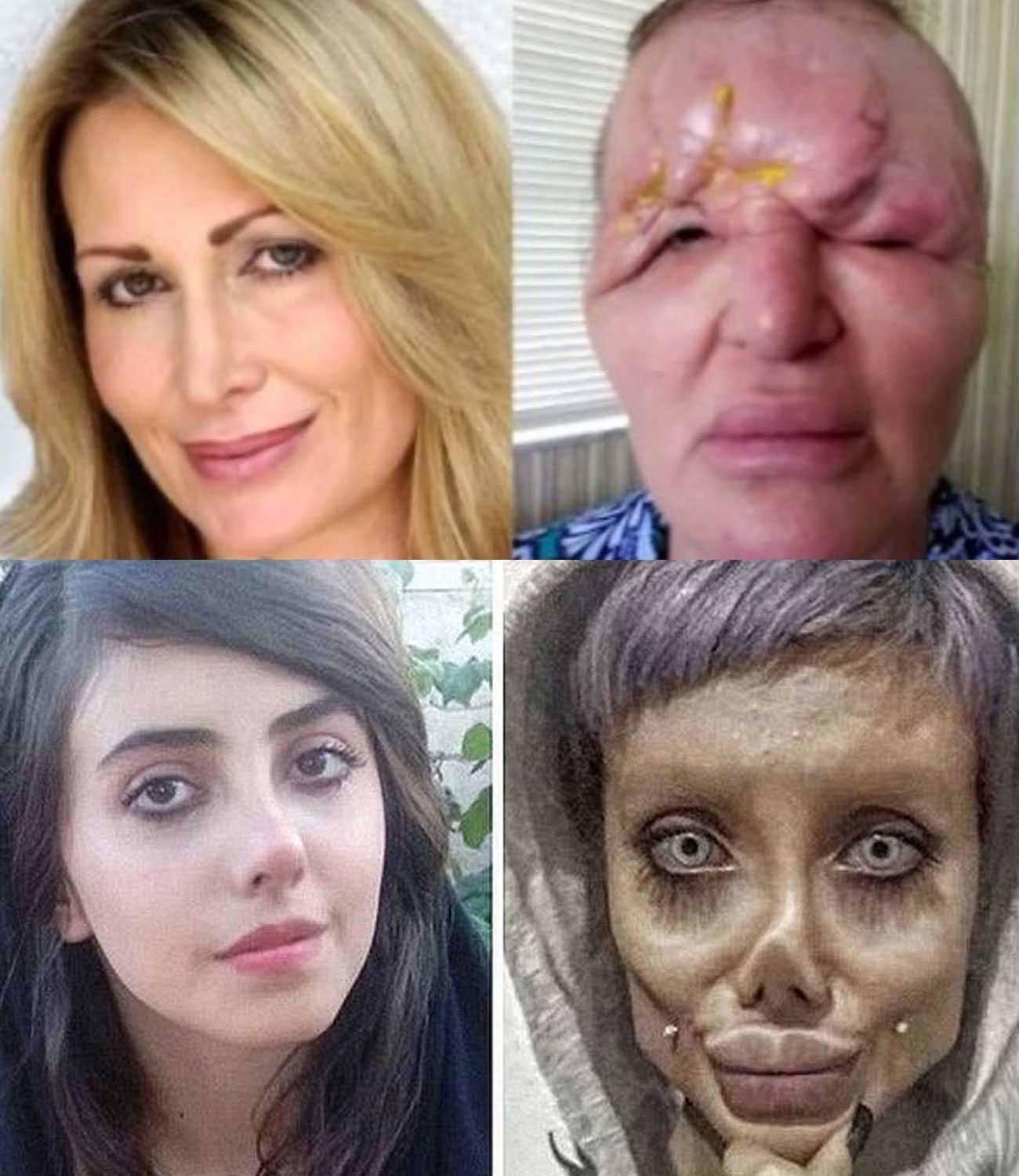 20 famous plastic surgery procedures gone wrong. When cosmetic surgery gets out of control: stories, downfalls, and resilience of celebrities.