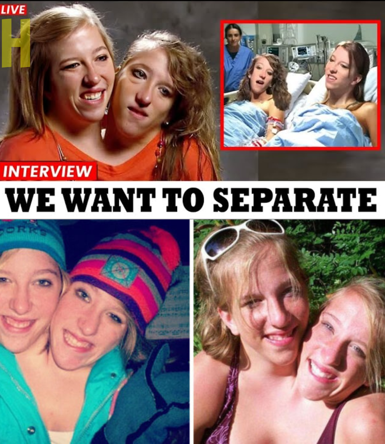 After the Surgery, Abby and Brittany Share Their New Lives