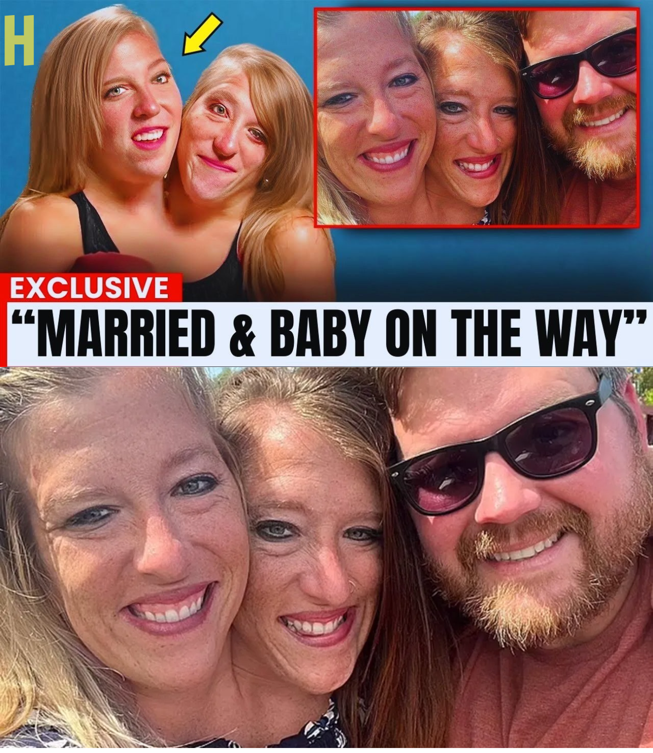 Conjoined Twins Abby & Brittany: The Story Behind Their Incredible Life