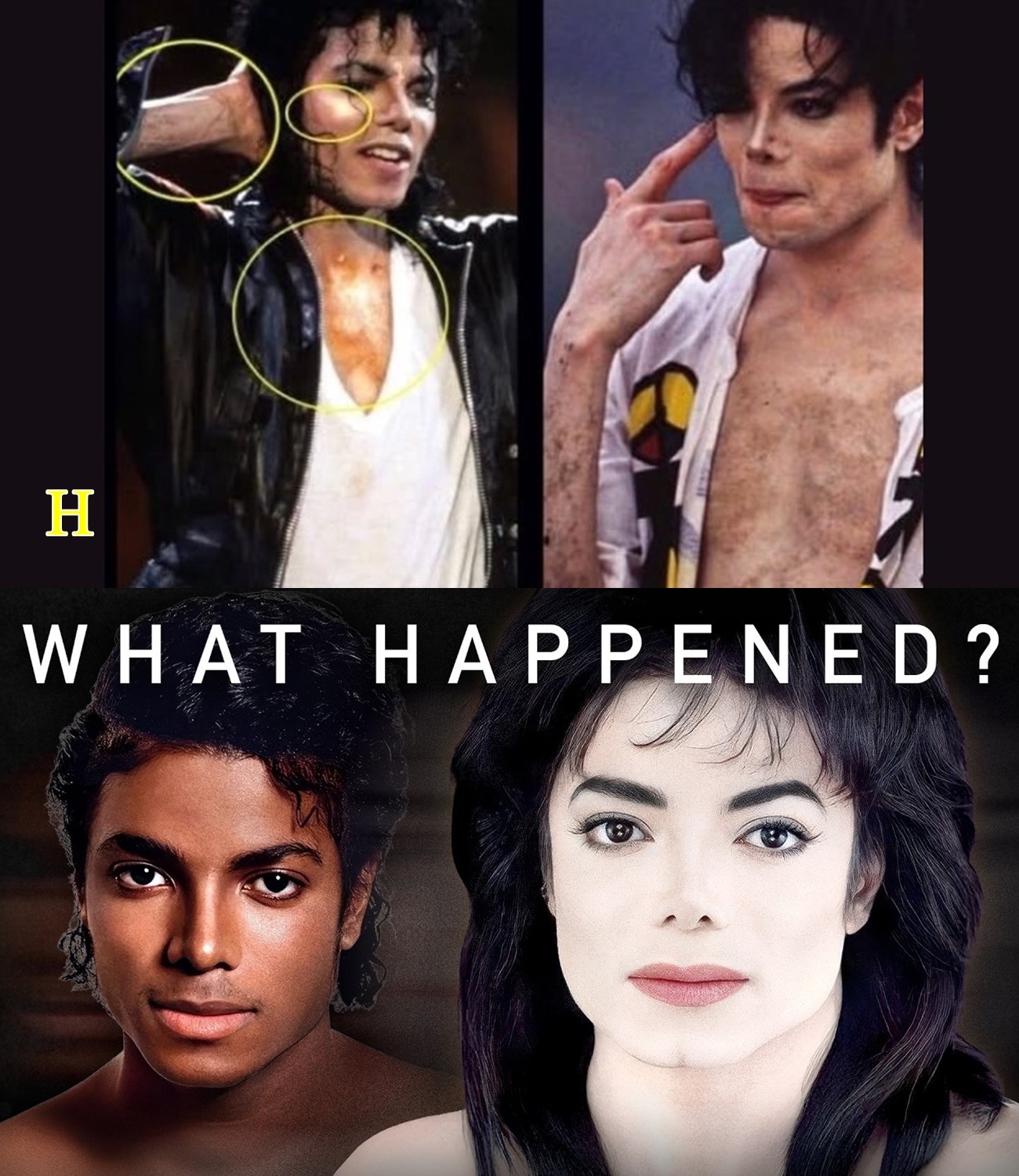 Michael Jackson’s Skin: The Truth About Vitiligo, Depigmentation and Bleaching