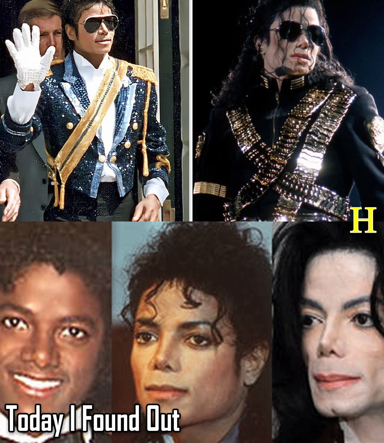 Why Michael Jackson’s Skin Turned White as He Got Older